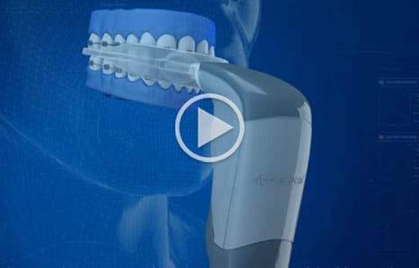 Acceledent Video Thumbnail Nelson Orthodontics in Raleigh and Fayetteville NC